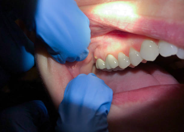 Best Emergency Dental Care for Broken or Chipped Teeth in Palo, IA