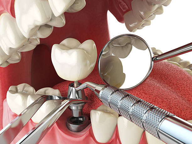 Best Emergency Tooth Extraction in Palo, IA